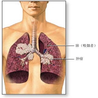 肺癌与饮食关系 维生素C可预防癌症